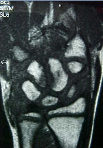 Figure 3 for case Psoriatic arthritis on the wrist